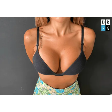 risultato mastopessi con protesi