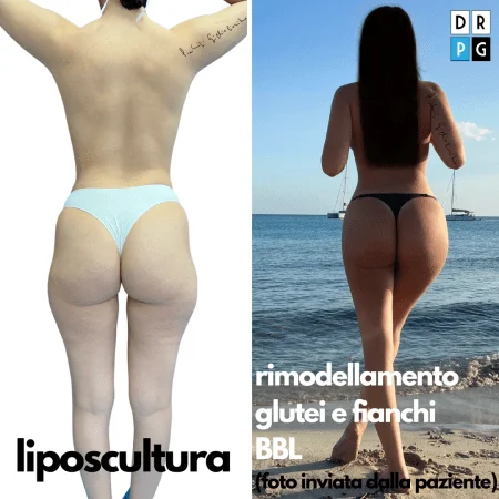 liposuzione prima e dopo