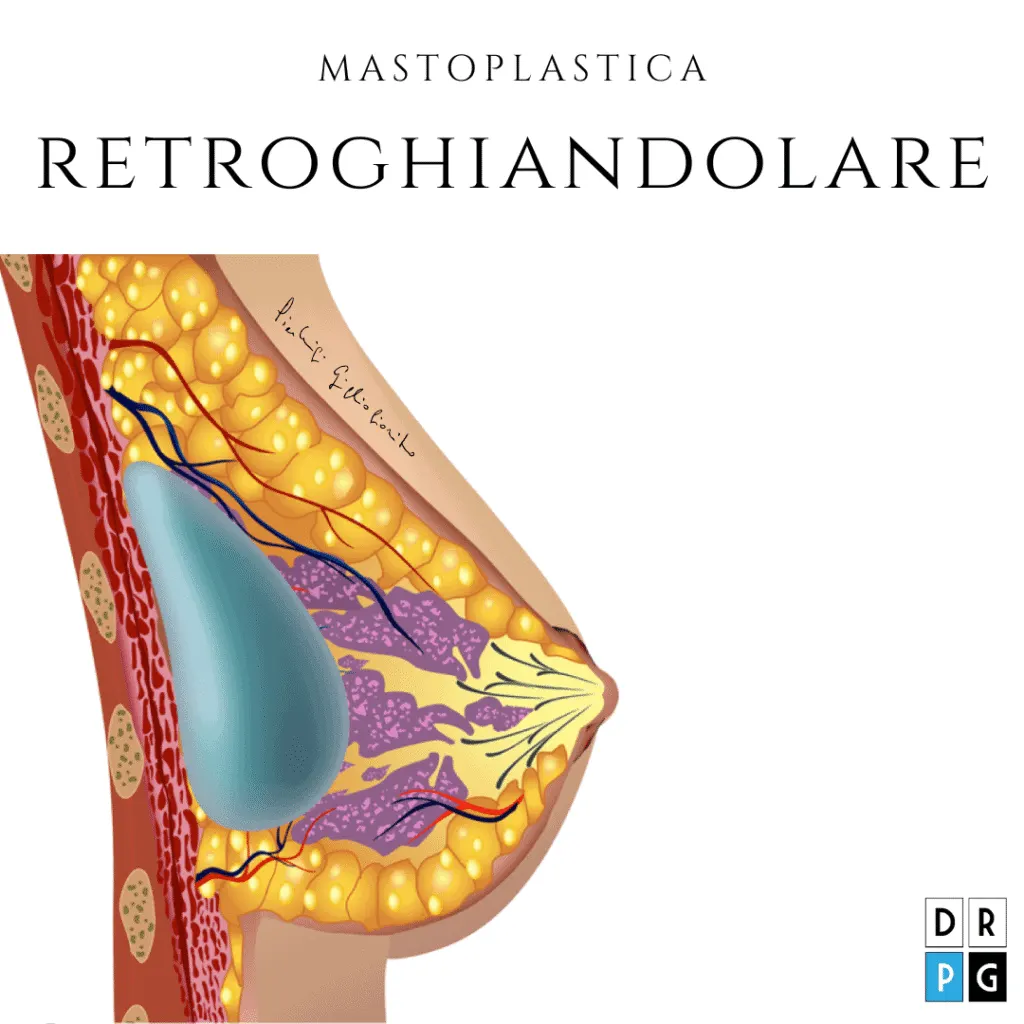 mastoplastica additiva retroghiandolare