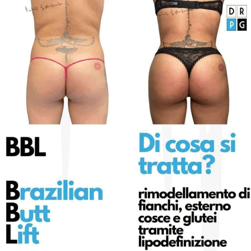 Brazilian Butt Lift e liposcultura per rimodellamento di fianchi e glutei
