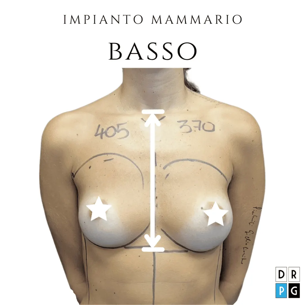mammella bassa décolleté vuoto: indicazione alla mastoplastica ibrida