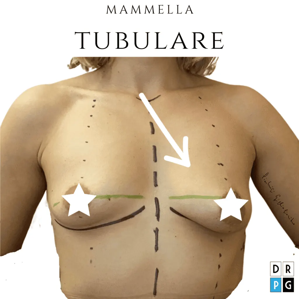 Correzione seno tuberoso con mastoplastica ibrida