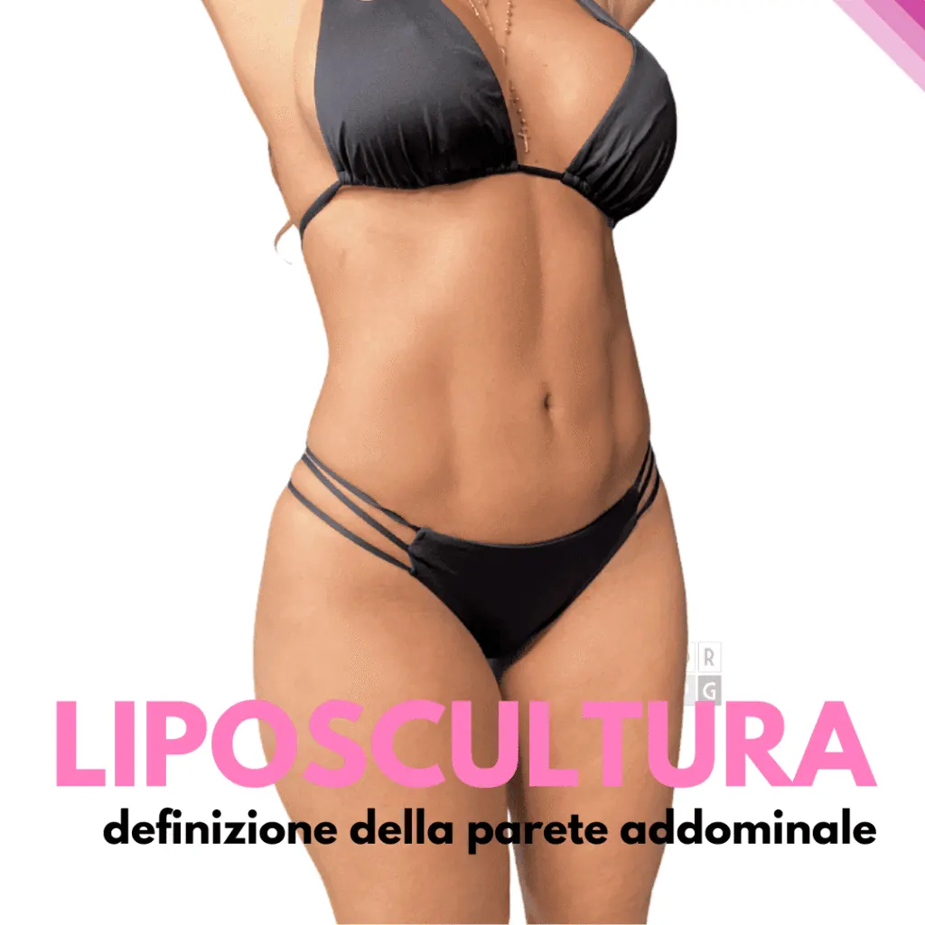 Liposcultura addominale per definizione della parete addominale – Dr. Pierluigi Gigliofiorito