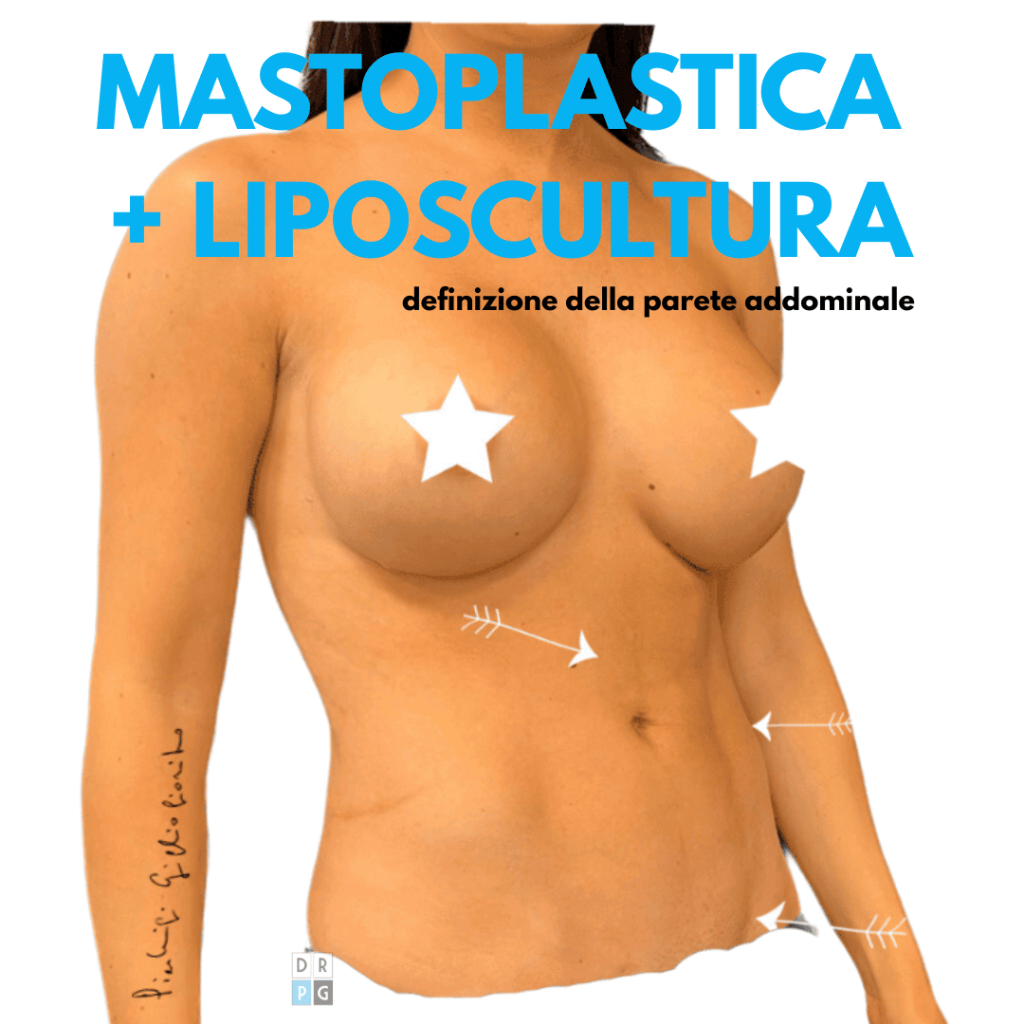 Mastoplastica additiva associata a liposcultura per armonizzazione del corpo
