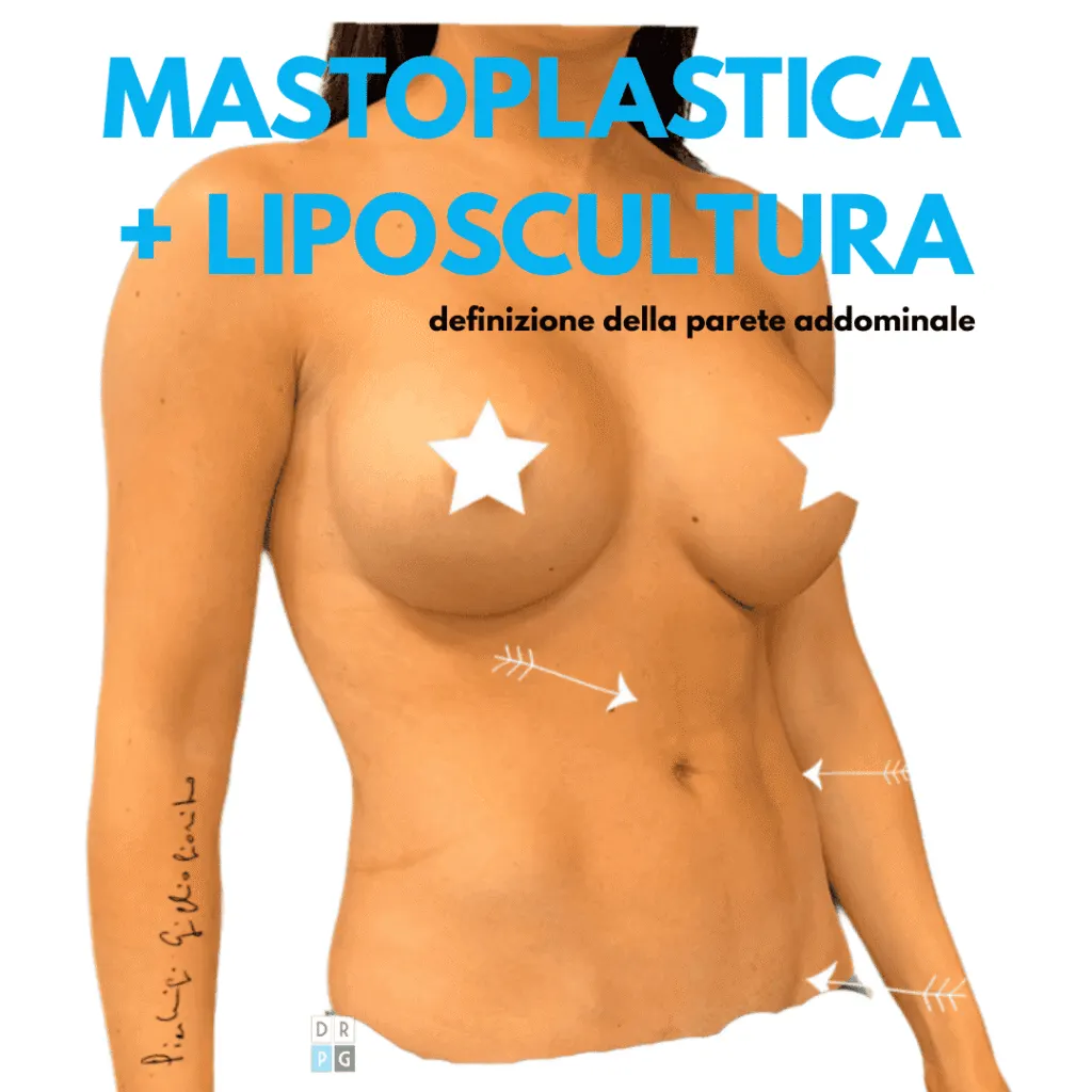 Mastoplastica additiva associata a liposcultura per armonizzazione del corpo
