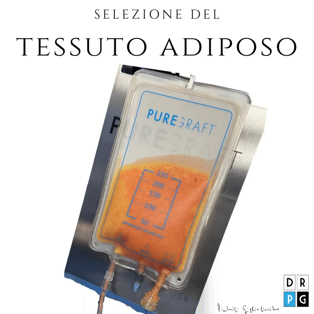 lipofilling di grasso per Mastoplastica Ibrida