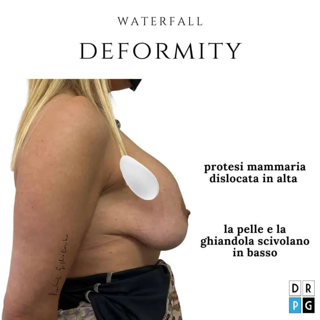 waterfall deformity e indicazioni alla rete di Galaflex