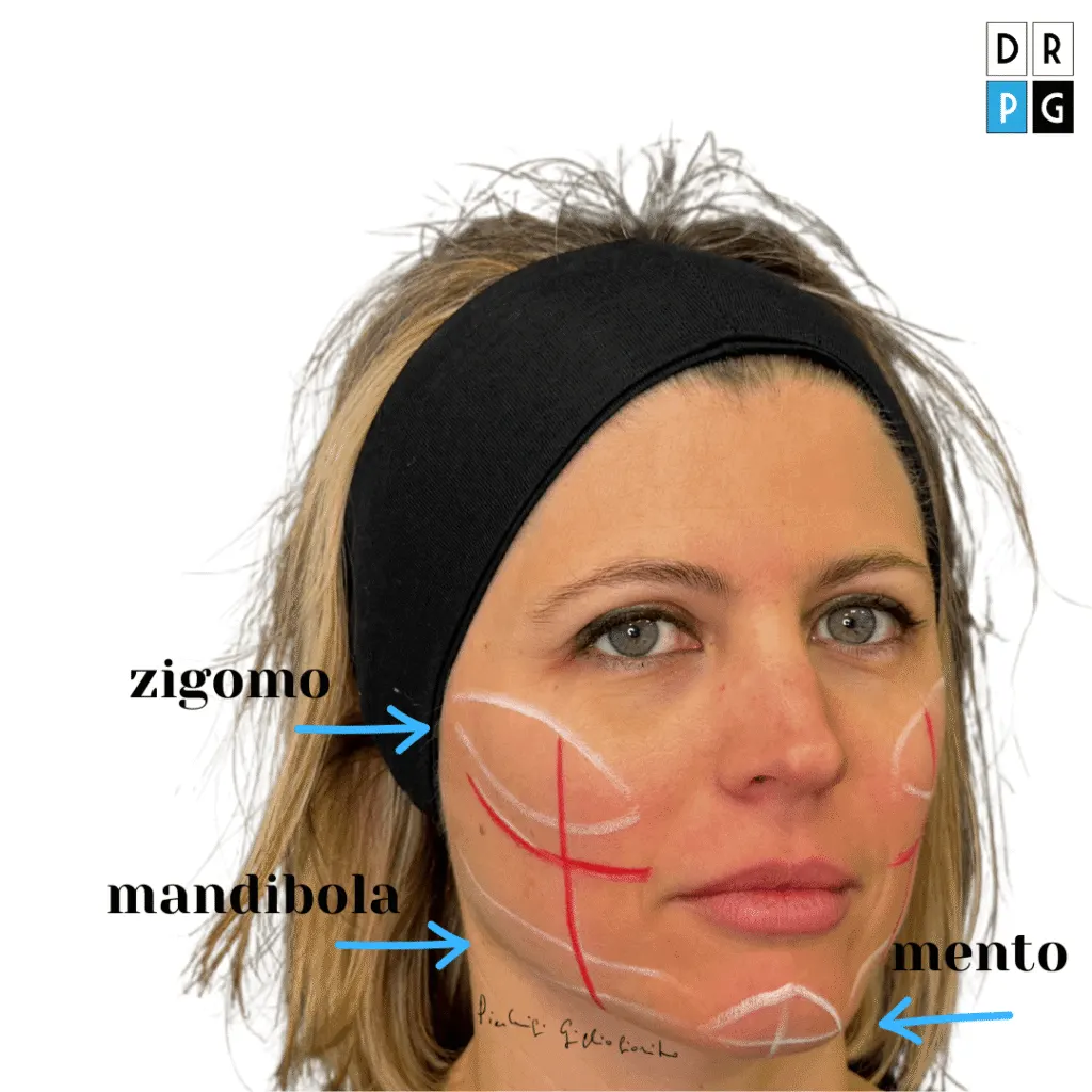 trattamento estetico full face: zigomi, mandibola e mento