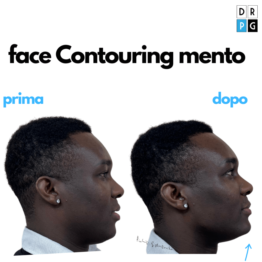 face contouring mento