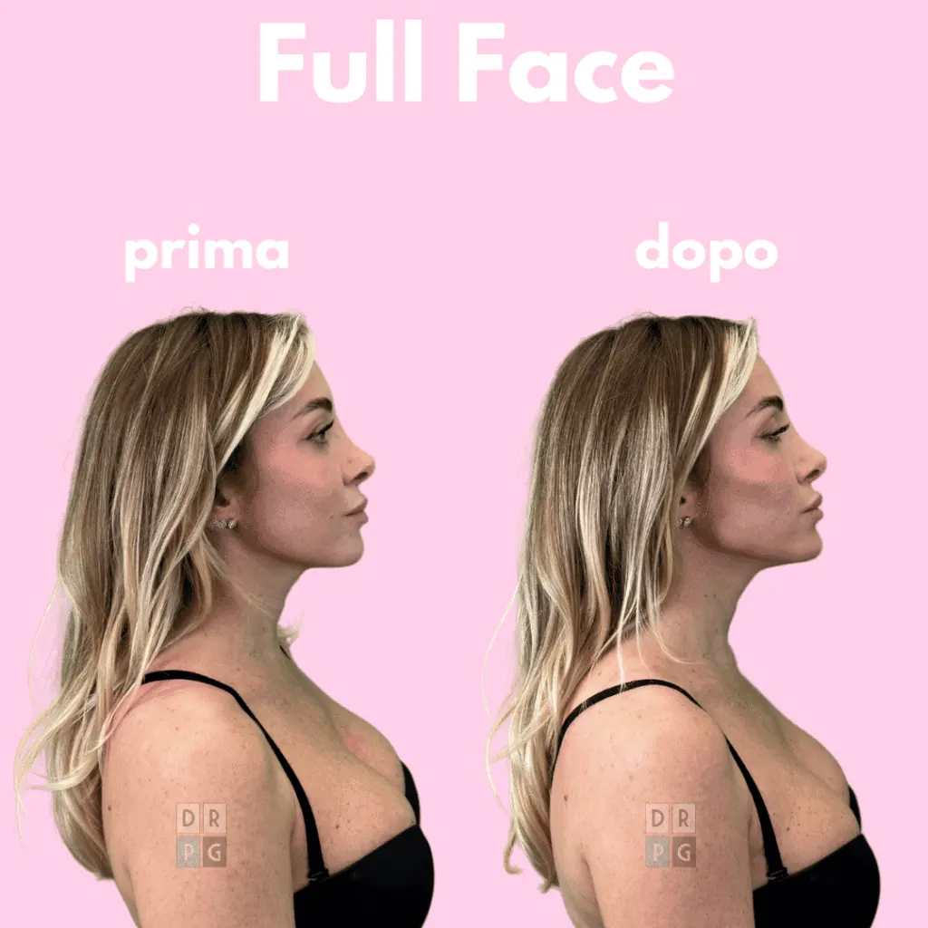 Risultato del Full Face Contouring con filler dinamici: miglioramento di zigomi, mento e mandibola – prima e dopo.