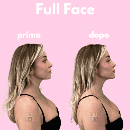 Risultato del Full Face Contouring con filler dinamici: miglioramento di zigomi, mento e mandibola – prima e dopo.