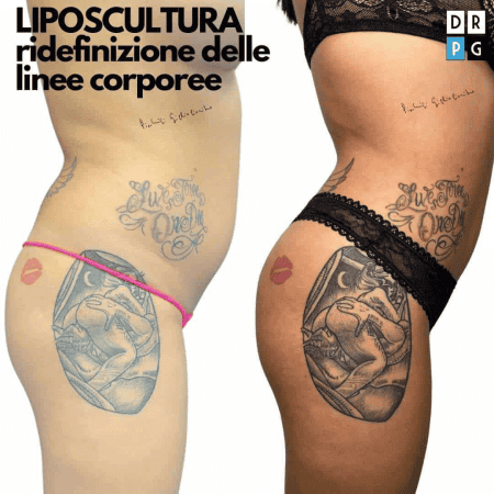 Liposuzione e liposcultura fianchi prima e dopo – Dr. Pierluigi Gigliofiorito