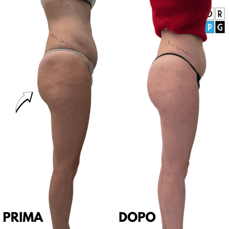 trattamento cellulite a milano e caserta