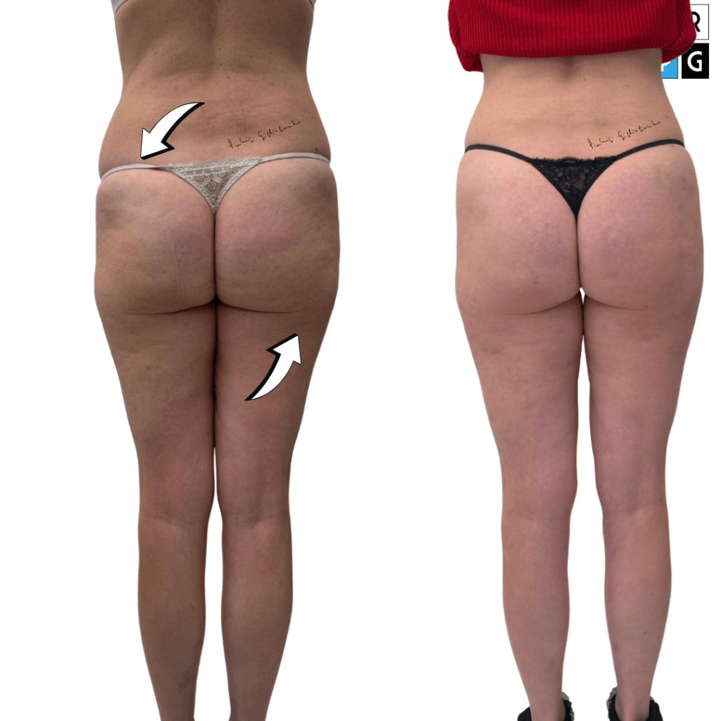 carbossiterapia cellulite prima e dopo