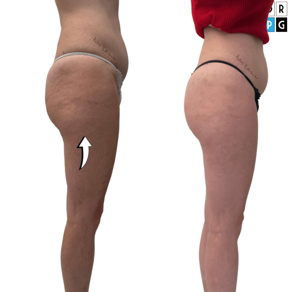 rimedi per la cellulite a buccia d'arancia