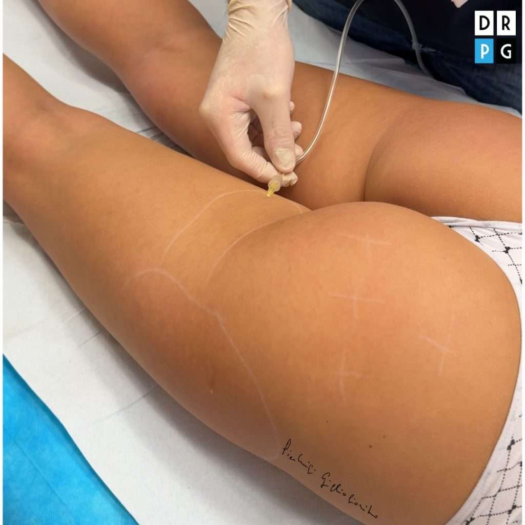 trattamento cellulite