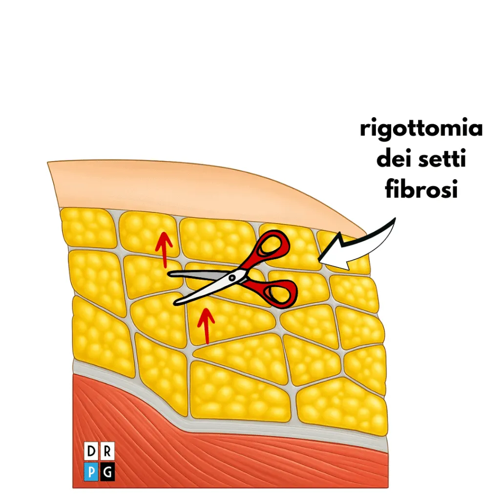 subcision cellulite