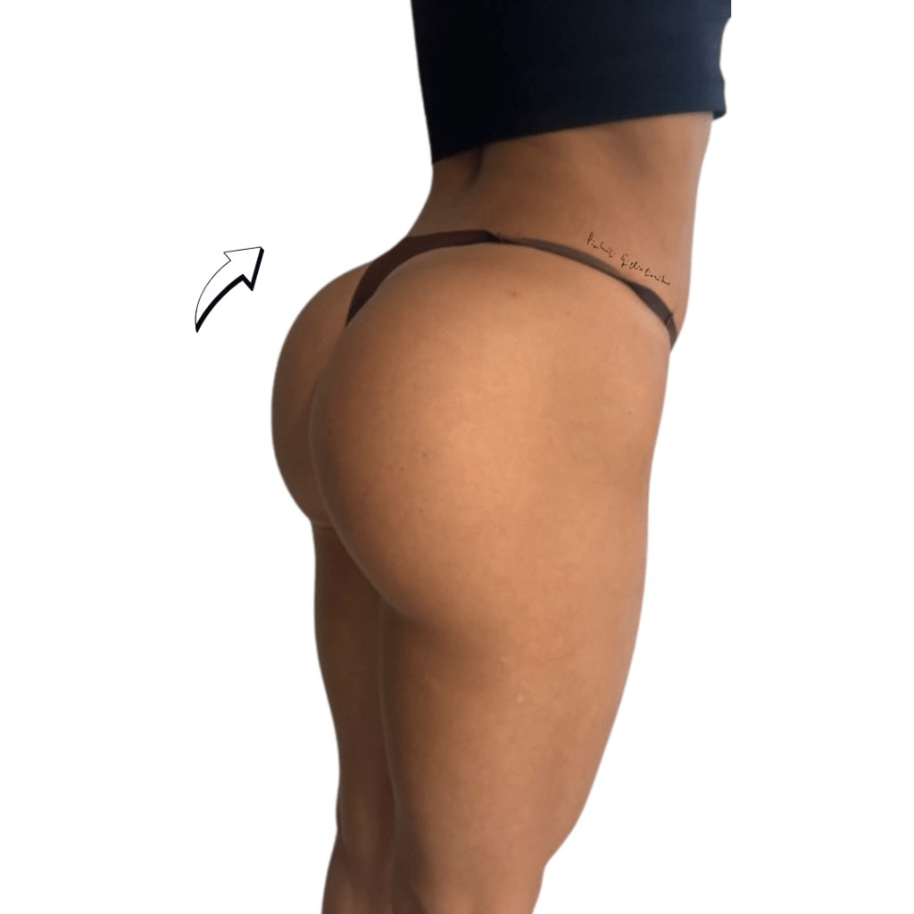 filler glutei acido ialuronico dopo trattamento