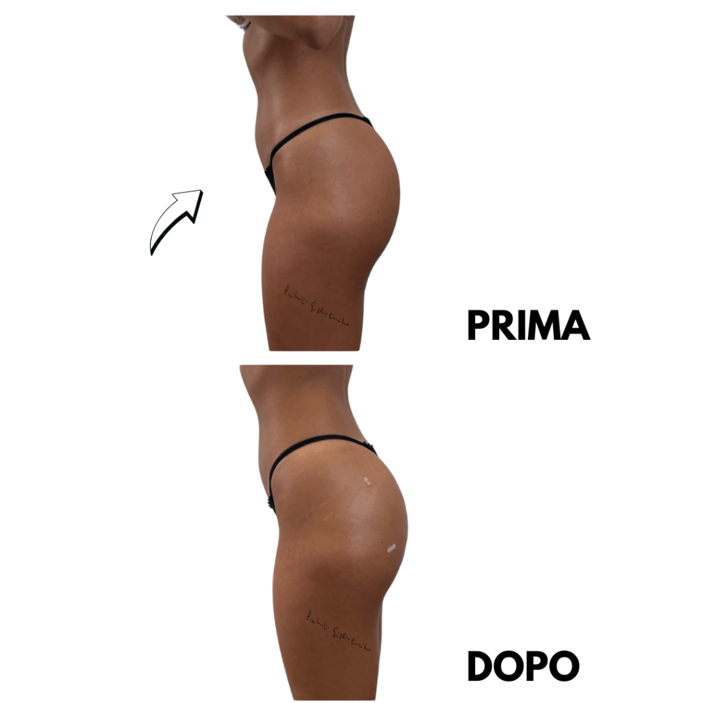 risultati naturali filler glutei Dr Gigliofiorito Milano Roma Caserta