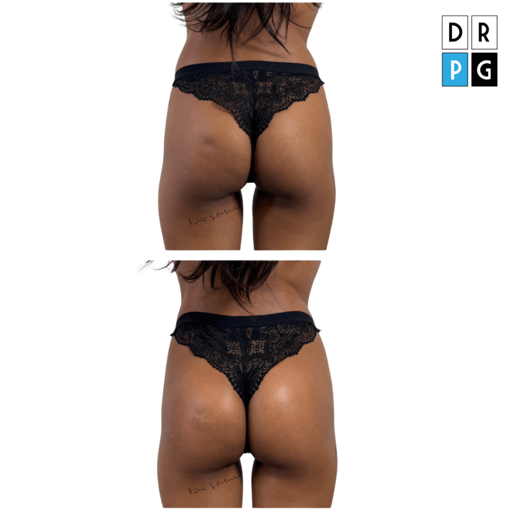 filler glutei acido ialuronico prima e dopo