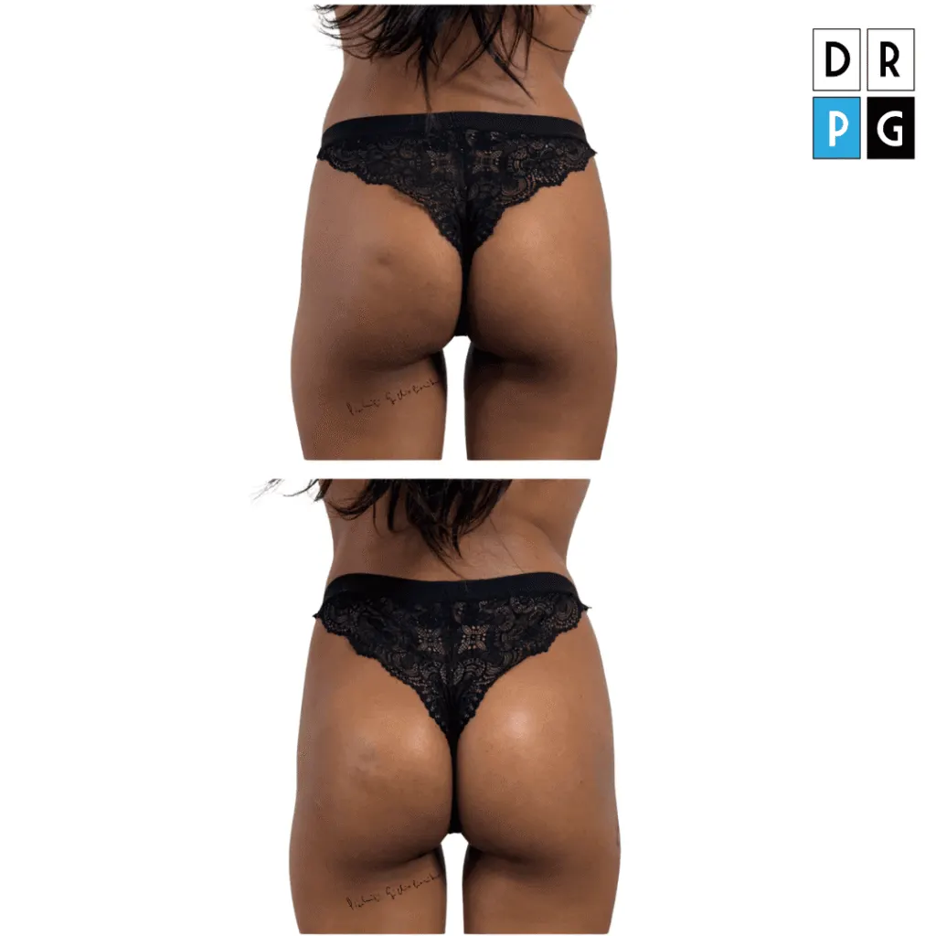 filler glutei acido ialuronico prima e dopo