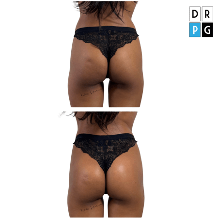 filler glutei acido ialuronico prima e dopo