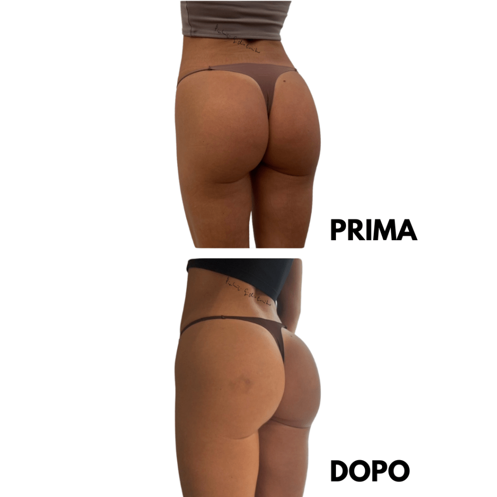 risultati naturali filler glutei prima e dopo