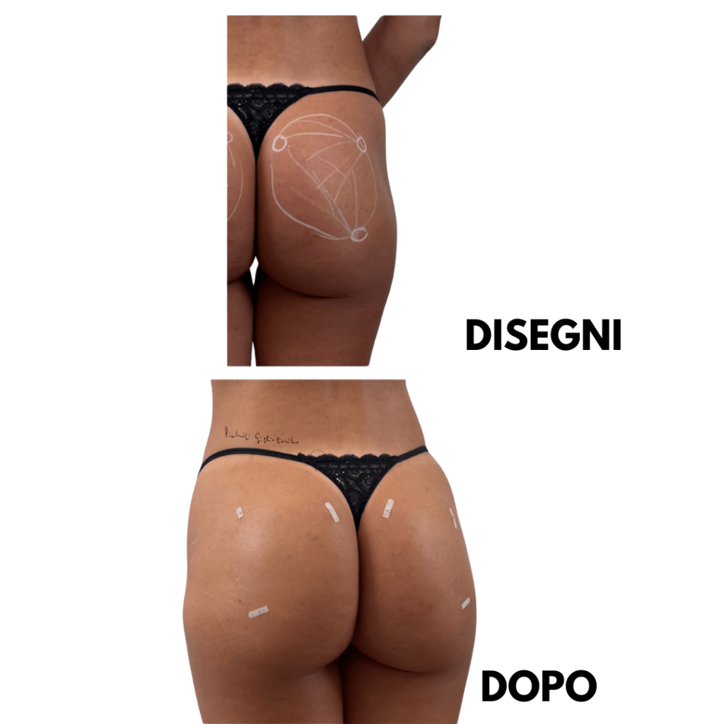 filler glutei acido ialuronico prima e dopo trattamento