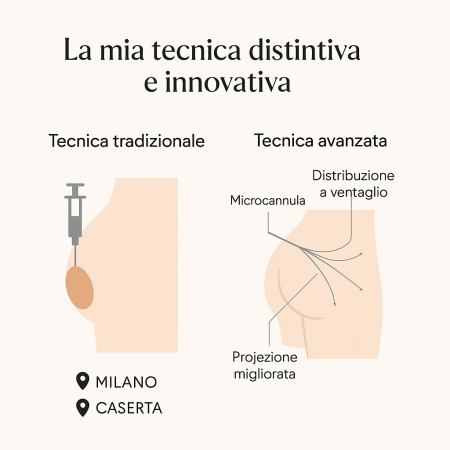 tecnica iniettiva filler glutei