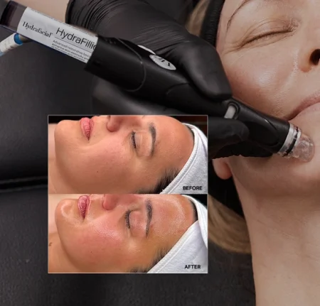 prima e dopo hydrafacial milano