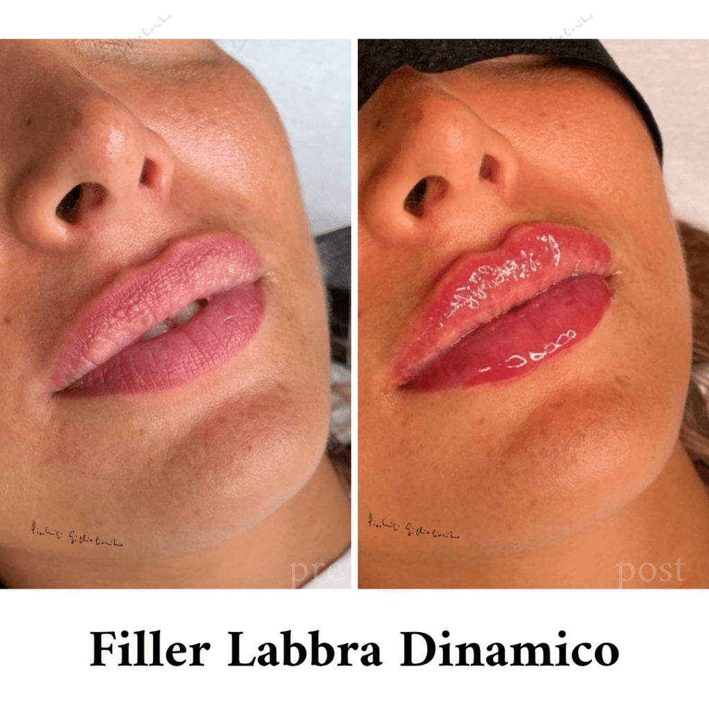 filler labbra dinamico a milano