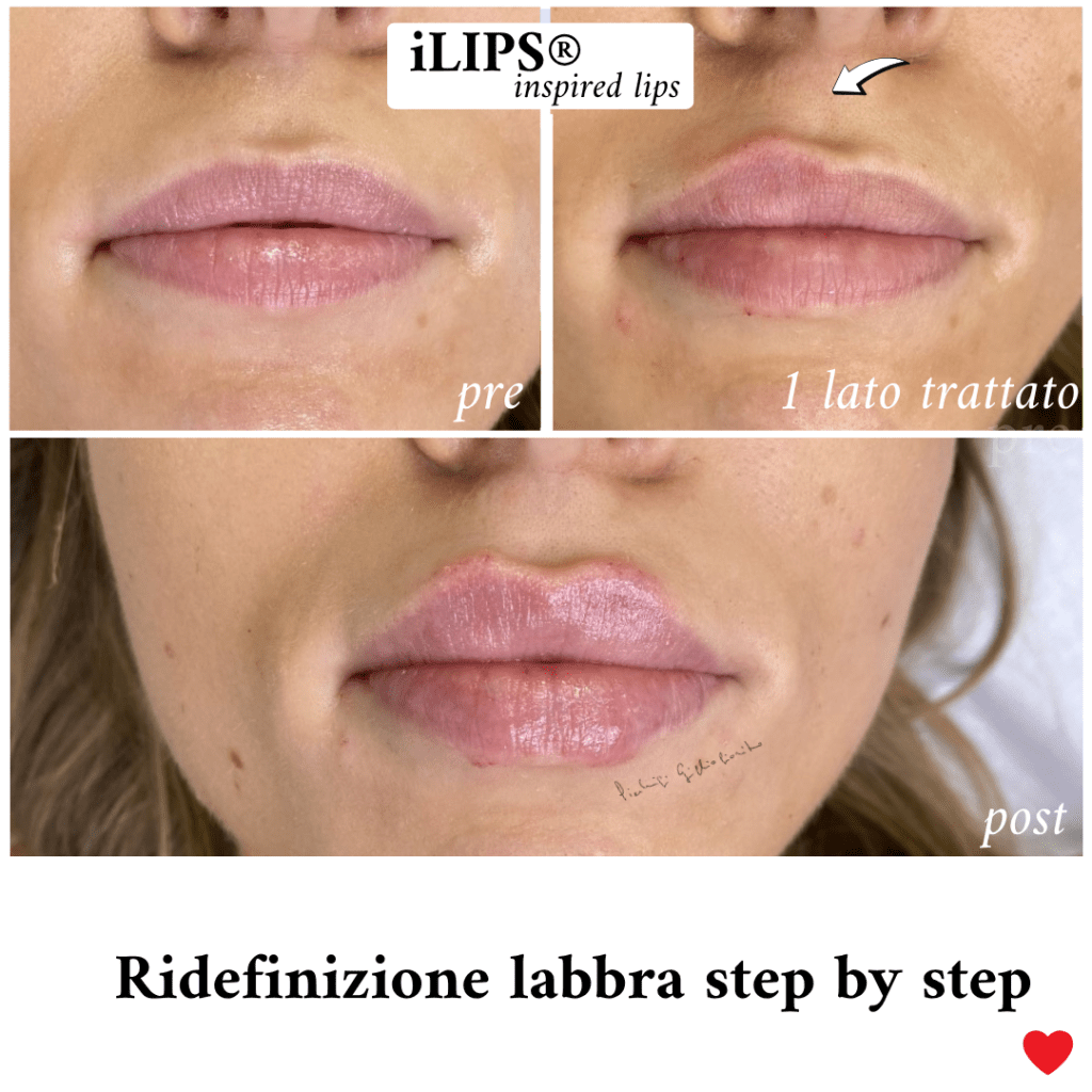 filler labbra prima e dopo