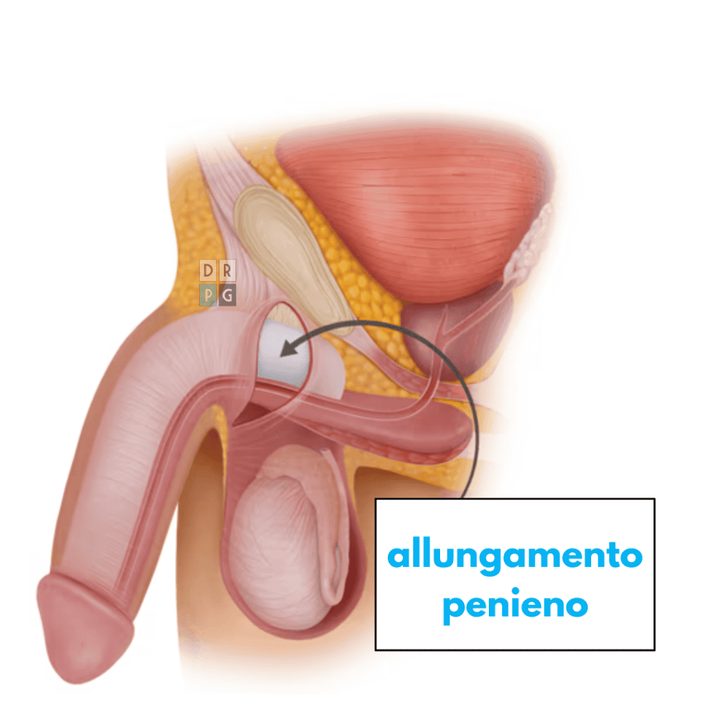 allungamento pene milano dr. barletta