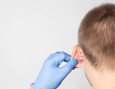 otoplastica, intervento chirurgico