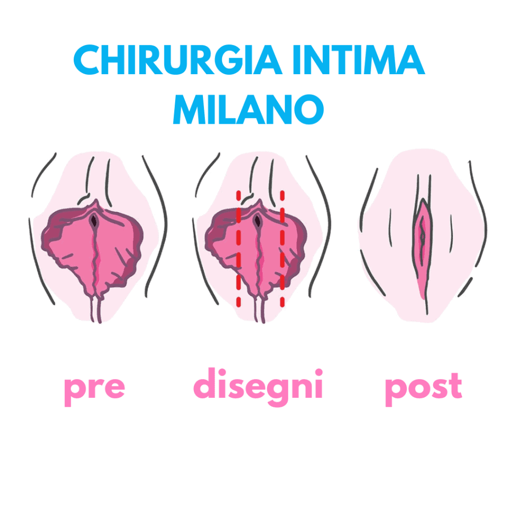 correzione ipertrofia piccole labbra milano
