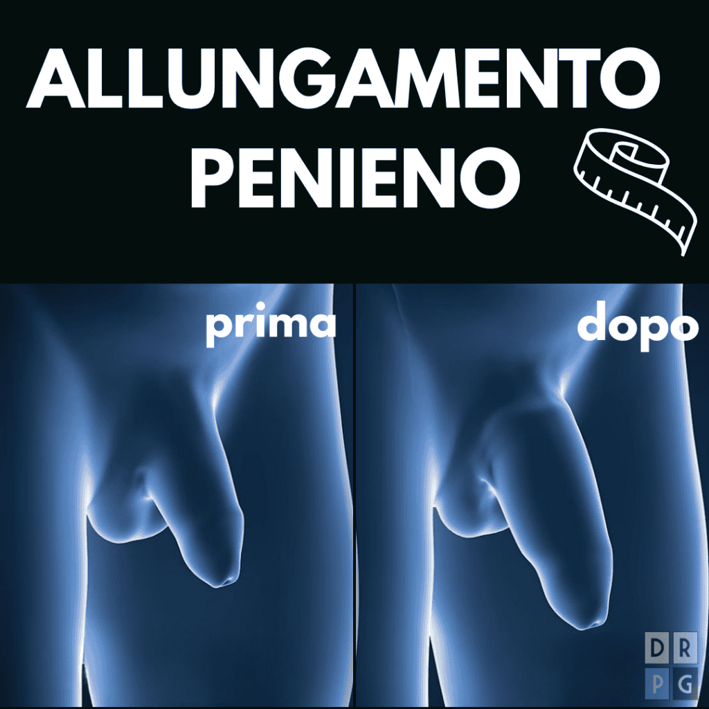 tecnica di allungamento del pene prima e dopo a milano