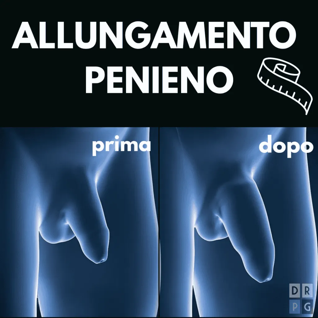 tecnica di allungamento del pene prima e dopo a milano