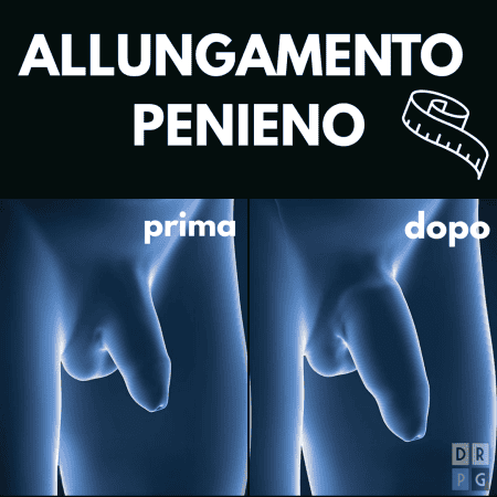 tecnica di allungamento del pene prima e dopo a milano