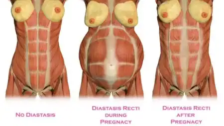 Esempio di diastasi addominale con separazione dei muscoli retti dopo gravidanza