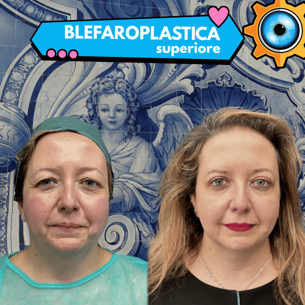 Blefaroplastica superiore prima e dopo a Milano, risultato naturale senza cicatrici visibili