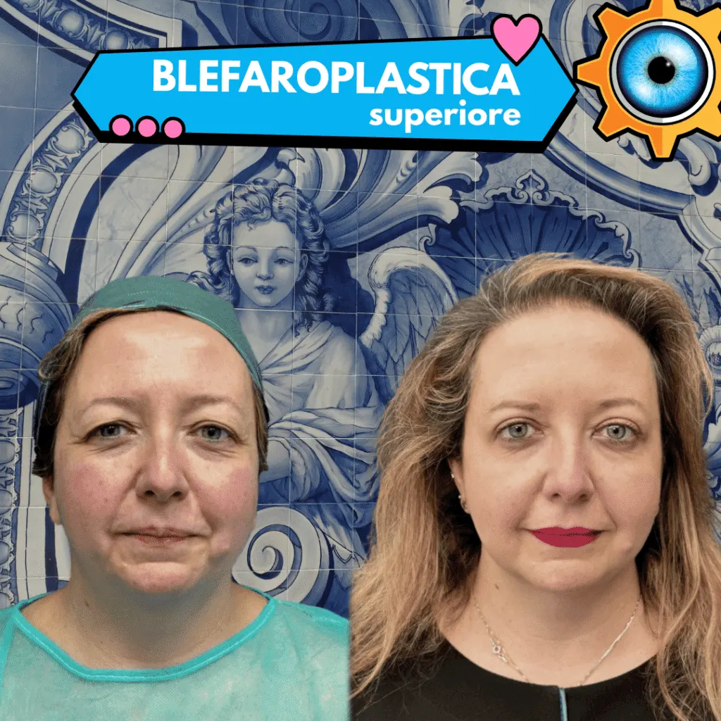Blefaroplastica superiore prima e dopo a Milano, risultato naturale senza cicatrici visibili