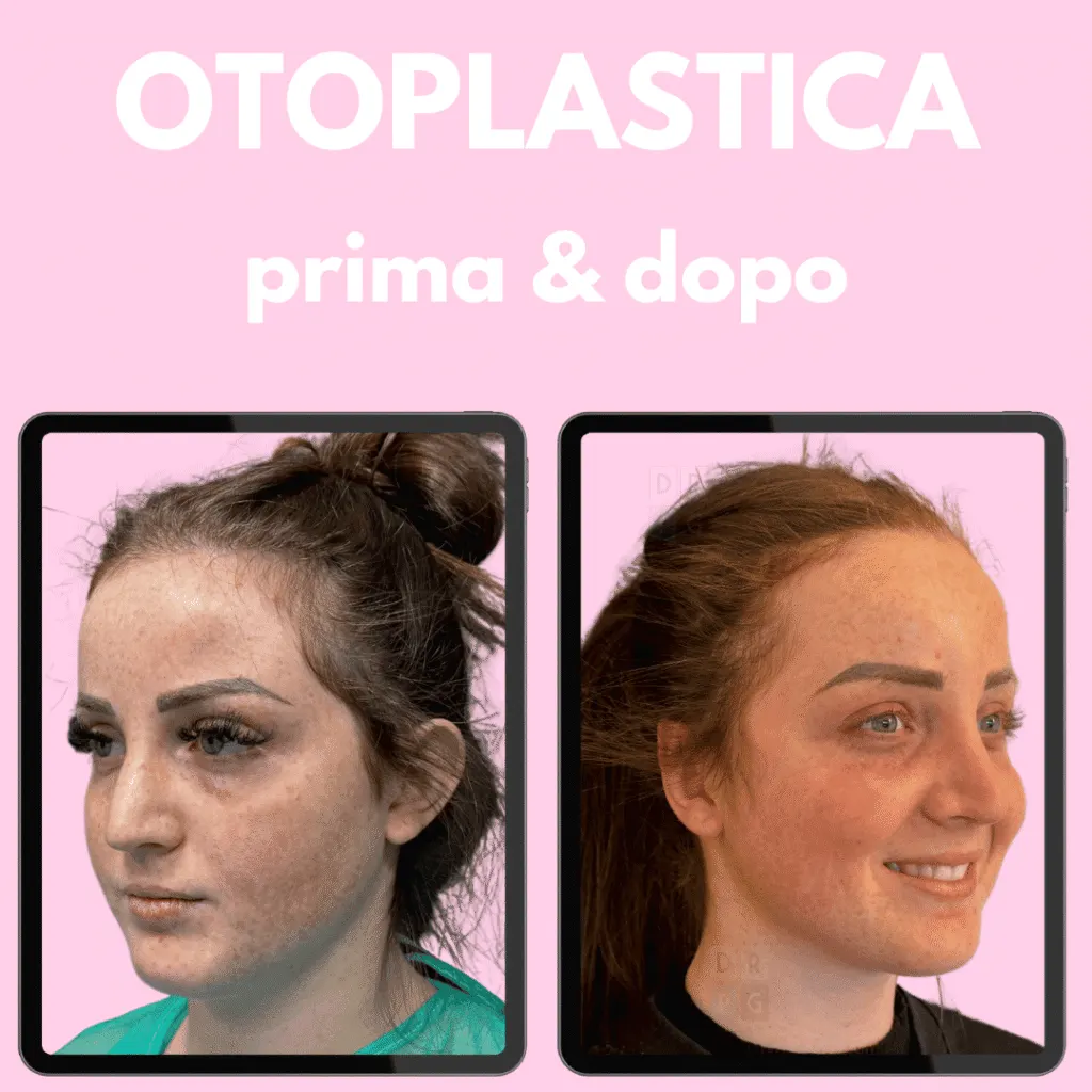otoplastica prima e dopo risultati naturali dr gigliofiorito