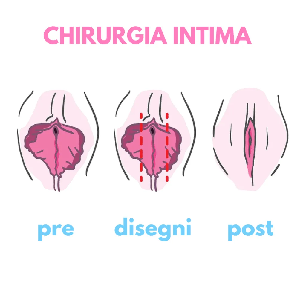 Labioplastica funzionale e estetica per migliorare comfort e benessere femminile