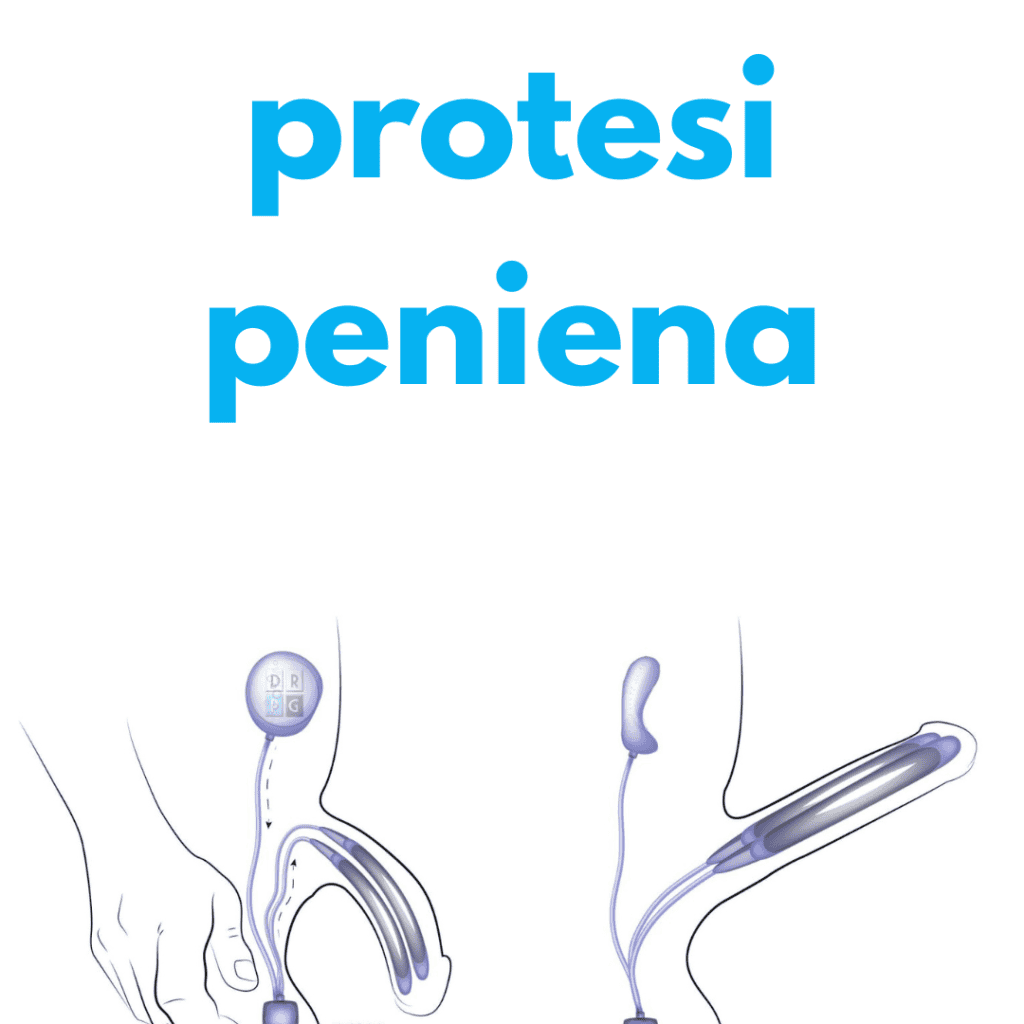 protesi peniena milano dr. barletta