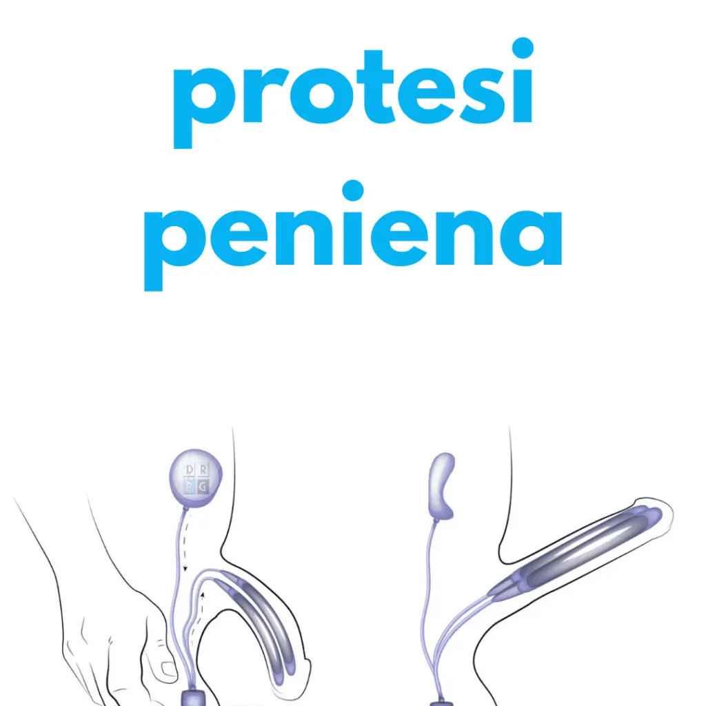 protesi peniena milano dr. barletta