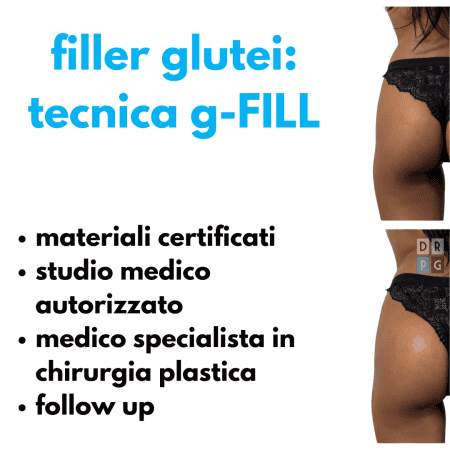 prima e dopo filler glutei Napoli studio medico