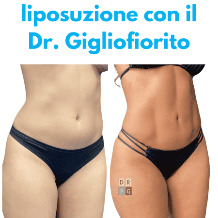 risultato prima e dopo dopo liposuzione Napoli corpo definito