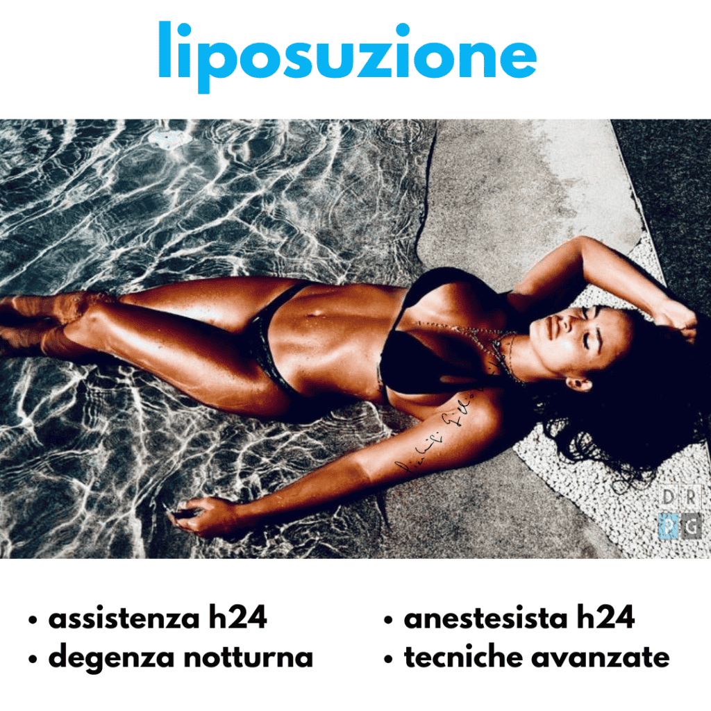risultato dopo liposuzione Napoli corpo definito