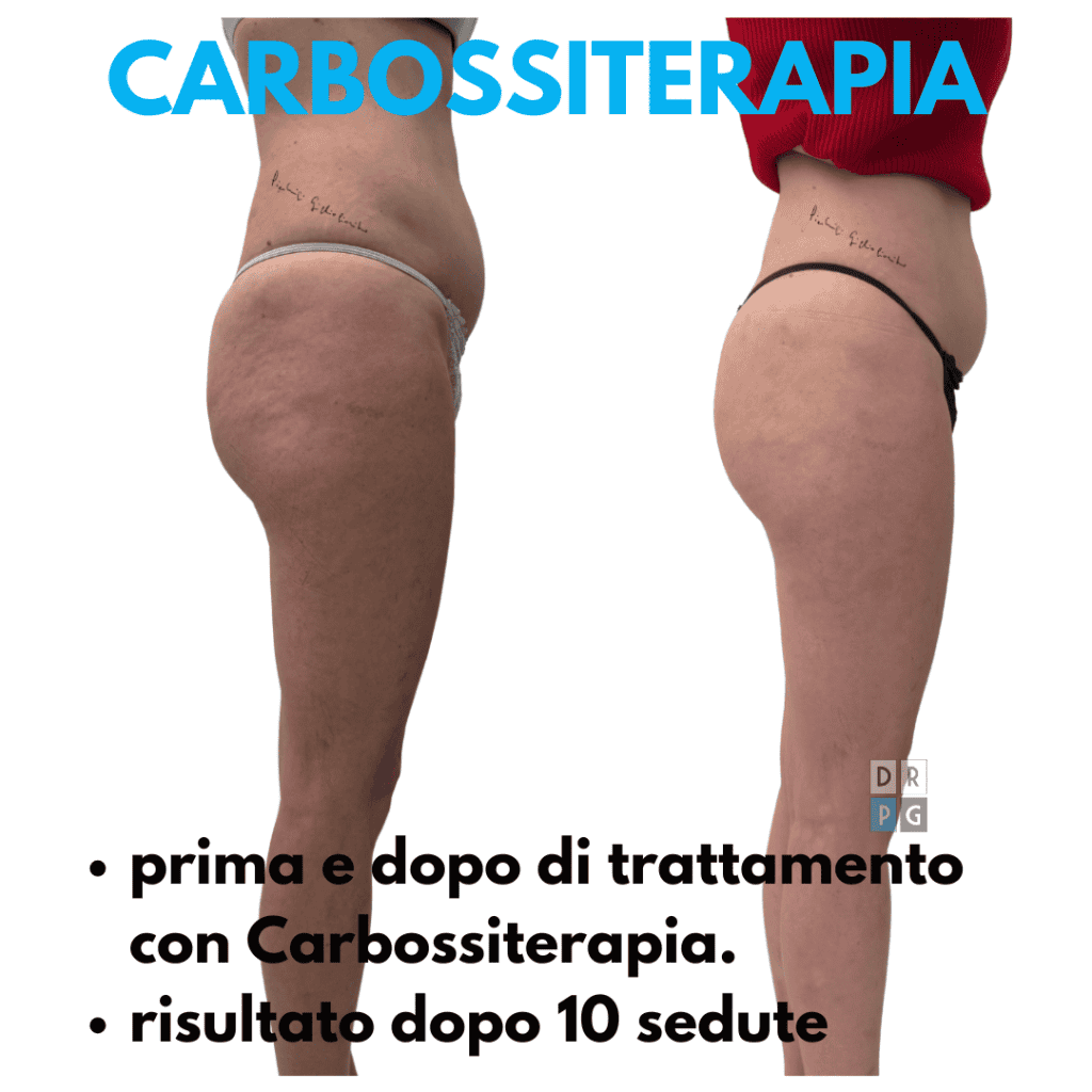 risultati prima e dopo carbossiterapia caserta per cellulite e microcircolo, pelle più liscia e tonica