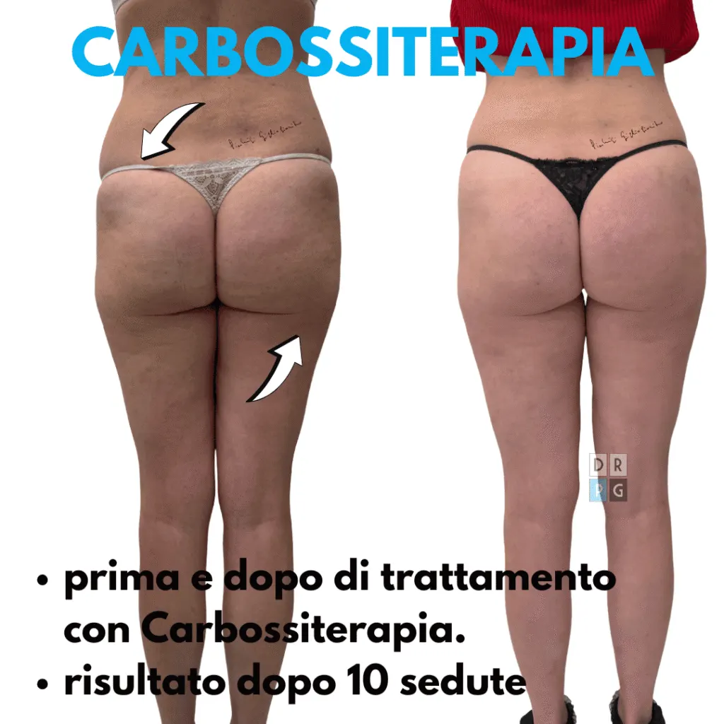 Resultados de antes e depois da carboxiterapia em Milão para celulite e microcirculação, pele mais lisa e tonificada.